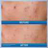 CeraVe Acne Control Gel 2% Salicylic Acid 1.35 Fl Oz